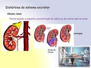 Distúrbios do sistema excretor
Cálculos renais
Forma quando a aumenta concentração de cálcio ou de outros sais na urina
Ondas de
choque
Litotripsia
 