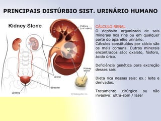 PRINCIPAIS DISTÚRBIO SIST. URINÁRIO HUMANO
CÁLCULO RENAL
O depósito organizado de sais
minerais nos rins ou em qualquer
parte do aparelho urinário.
Cálculos constituídos por cálcio são
os mais comuns. Outros minerais
encontrados são: oxalato, fósforo,
ácido úrico.
Deficiência genética para excreção
desses sais
Dieta rica nessas sais: ex.: leite e
derivados.
Tratamento cirúrgico ou não
invasivo: ultra-som / laser
 