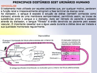 PRINCIPAIS DISTÚRBIO SIST URINÁRIO HUMANO
HEMODIÁLISE
O tratamento mais utilizado por aqueles pacientes que, por qualquer motivo, perderam
a função renal e irreparavelmente atingiram a fase terminal da doença renal.
No dialisador, o sangue é exposto à solução de diálise (também conhecida como
dialisato) através de uma membrana semipermeável, permitindo assim, as trocas de
substâncias entre o sangue e o dialisato. Após ser retirado do paciente e passado
através do dialisador, o sangue “filtrado” é então devolvido ao paciente pelo acesso
vascular. É importante ressaltar que a água usada durante a diálise deve ser tratada e
sua qualidade monitorada regularmente.
PRINCIPAIS DISTÚRBIO SIST URINÁRIO HUMANO
HEMODIÁLISE
O tratamento mais utilizado por aqueles pacientes que, por qualquer motivo, perderam
a função renal e irreparavelmente atingiram a fase terminal da doença renal.
No dialisador, o sangue é exposto à solução de diálise (também conhecida como
dialisato) através de uma membrana semipermeável, permitindo assim, as trocas de
substâncias entre o sangue e o dialisato. Após ser retirado do paciente e passado
através do dialisador, o sangue “filtrado” é então devolvido ao paciente pelo acesso
vascular. É importante ressaltar que a água usada durante a diálise deve ser tratada e
sua qualidade monitorada regularmente.
 