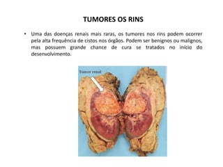 TUMORES OS RINS
• Uma das doenças renais mais raras, os tumores nos rins podem ocorrer
pela alta frequência de cistos nos órgãos. Podem ser benignos ou malignos,
mas possuem grande chance de cura se tratados no início do
desenvolvimento.
 