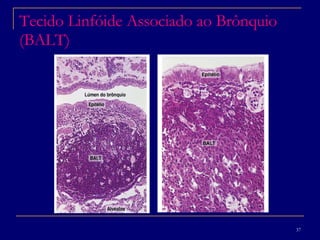 Tecido Linfóide Associado ao Brônquio (BALT) 