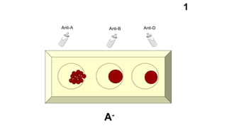 Anti-A Anti-B Anti-D
1
A-
 