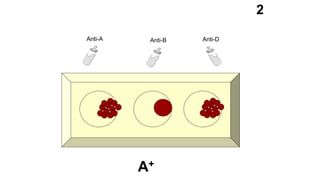 Anti-A Anti-B Anti-D
2
A+
 