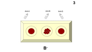 Anti-A Anti-B Anti-D
3
B-
 