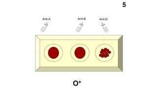 Anti-A Anti-B Anti-D
5
O+
 