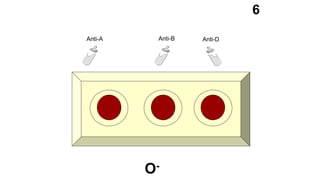 Anti-A Anti-B Anti-D
6
O-
 