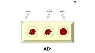 Anti-A Anti-B Anti-D
7
AB-
 