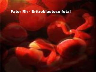 Fator Rh - Eritroblastose fetal
 