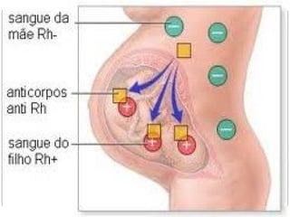  Normalmente, os cuidados com o recém-nascido
 afetado pela doença envolvem a fotossensibilização
 (luz néon, que destrói a bilirrubina) e a substituição
 do sangue Rh+ da criança por sangue Rhֿ.


 A maioria das hemorragias transplacentais ocorre na
 hora do parto. Se a passagem em quantidade de
 hemácias do sangue do feto para o sangue da mãe
 for detectada, pode-se administrar gamaglobulina
 anti-Rh, eliminando as hemácias fetais do sangue
 materno, evitando assim a sensibilização e a possível
 concepção de um bebê com eritroblastose.
 
