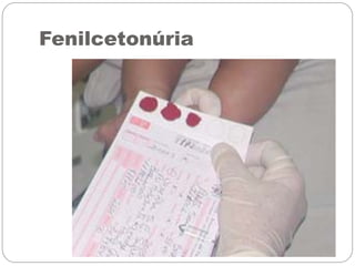 Fenilcetonúria
 