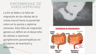 .
ENFERMEDAD DE
HIRSCHSPRUNG
La EH se debe a la falta de
migración de las células de la
cresta neural hacia la pared del
colon en la quinta a séptima
semanas. Esta falta de migración
genera un déficit en el desarrollo
de células o neuronas
ganglionares parasimpáticas en
los plexos de Auerbach y
Meissner.
 