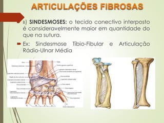  B) SINDESMOSES: o tecido conectivo interposto
é consideravelmente maior em quantidade do
que na sutura.
 Ex: Sindesmose Tíbio-Fibular e Articulação
Rádio-Ulnar Média
 