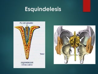 Esquindelesis
 