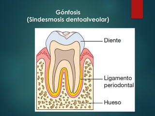 Gónfosis
(Sindesmosis dentoalveolar)
 