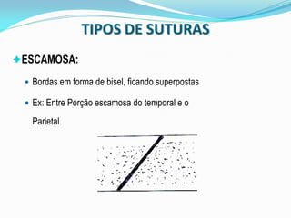 TIPOS DE SUTURAS
ESCAMOSA:

  Bordas em forma de bisel, ficando superpostas

  Ex: Entre Porção escamosa do temporal e o

   Parietal
 