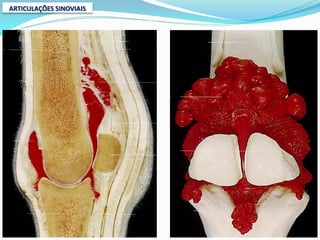 ARTICULAÇÕES SINOVIAIS
 