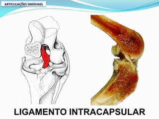 ARTICULAÇÕES SINOVIAIS




     LIGAMENTO INTRACAPSULAR
 
