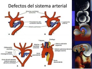 Defectos del sistema arterial
 