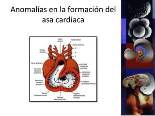 Anomalías en la formación del
asa cardiaca
 