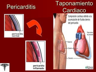 Pericarditis Taponamiento Cardiaco 