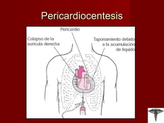 Pericardiocentesis 