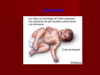 CIANOSIS 