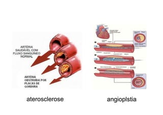 aterosclerose angioplstia
 