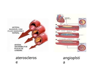 ateroscleros
e
angioplsti
a
 