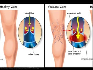 http://veincenteratjohnscreek.com/wp-content/uploads/2012/04/Stock-2.jpg
 