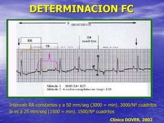 DETERMINACION FC
Intervalo RR constantes y a 50 mm/seg (3000 = min). 3000/Nº cuadritos
Si es a 25 mm/seg (1500 = min). 1500/Nº cuadritos
Clínica DOVER, 2002
 