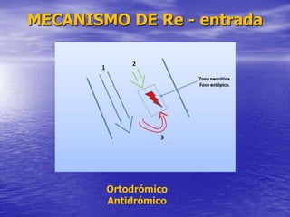 MECANISMO DE Re - entrada
Ortodrómico
Antidrómico
 
