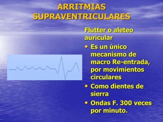 ARRITMIAS
SUPRAVENTRICULARES
Flutter o aleteo
auricular
• Es un único
mecanismo de
macro Re-entrada,
por movimientos
circulares
• Como dientes de
sierra
• Ondas F. 300 veces
por minuto.
 