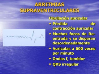 ARRITMIAS
SUPRAVENTRICULARES
Fibrilación auricular
• Pérdida de
contracción auricular
• Muchos focos de Re-
entrada y se disparan
desordenadamente
• Aurículas a 600 veces
por minuto
• Ondas f, temblor
• QRS irregular
 