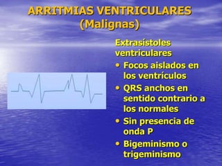 ARRITMIAS VENTRICULARES
(Malignas)
Extrasístoles
ventriculares
• Focos aislados en
los ventrículos
• QRS anchos en
sentido contrario a
los normales
• Sin presencia de
onda P
• Bigeminismo o
trigeminismo
 