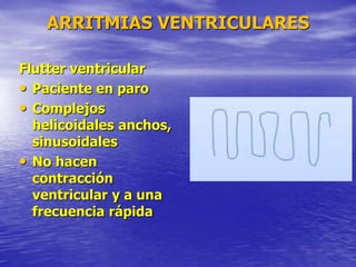 ARRITMIAS VENTRICULARES
Flutter ventricular
• Paciente en paro
• Complejos
helicoidales anchos,
sinusoidales
• No hacen
contracción
ventricular y a una
frecuencia rápida
 