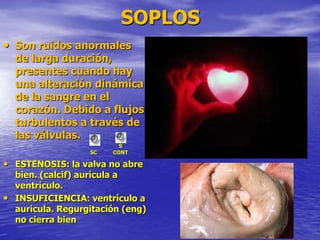 SOPLOS
• Son ruidos anormales
de larga duración,
presentes cuando hay
una alteración dinámica
de la sangre en el
corazón. Debido a flujos
turbulentos a través de
las válvulas.
• ESTENOSIS: la valva no abre
bien. (calcif) aurícula a
ventrículo.
• INSUFICIENCIA: ventrículo a
aurícula. Regurgitación (eng)
no cierra bien
SC
S
CONT
 