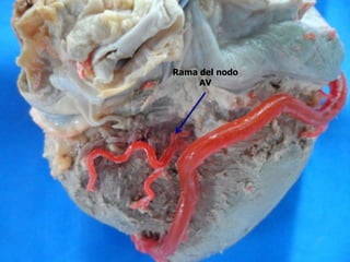 Rama del nodo
AV
 