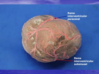 Rama
interventricular
paraconal
Rama
interventricular
subsinusal
 