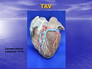 TAV
Cerrado inferior
y superior: 17%
 