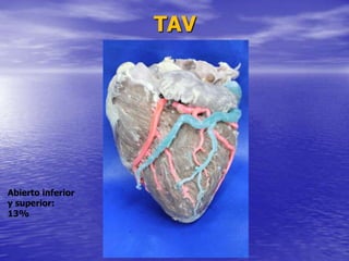 TAV
Abierto inferior
y superior:
13%
 