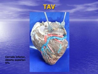 TAV
Cerrado inferior,
abierto superior:
5%
 