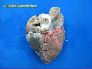 Puente Miocárdico
 