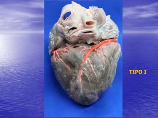 TIPO I
 