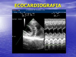 ECOCARDIOGRAFIA
 