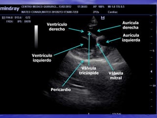 Ventrículo
izquierdo
Aurícula
izquierda
Aurícula
derecha
Ventrículo
derecho
Válvula
tricúspide Válvula
mitral
Pericardio
 