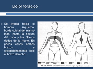 Dolor torácico
 Se irradia hacia el
hombro izquierdo,
borde cubital del mismo
lado, hasta la flexura
del codo y los últimos
dedos de la mano. En
pocos casos ambos
brazos y
excepcionalmente solo
al brazo derecho.
 