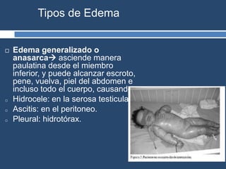 Tipos de Edema
 Edema generalizado o
anasarca asciende manera
paulatina desde el miembro
inferior, y puede alcanzar escroto,
pene, vuelva, piel del abdomen e
incluso todo el cuerpo, causando:
o Hidrocele: en la serosa testicular.
o Ascitis: en el peritoneo.
o Pleural: hidrotórax.
 