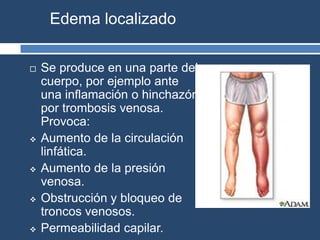 Edema localizado
 Se produce en una parte del
cuerpo, por ejemplo ante
una inflamación o hinchazón
por trombosis venosa.
Provoca:
 Aumento de la circulación
linfática.
 Aumento de la presión
venosa.
 Obstrucción y bloqueo de
troncos venosos.
 Permeabilidad capilar.
 