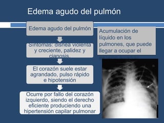 Edema agudo del pulmón
Síntomas: disnea violenta
y creciente, palidez y
cianosis.
El corazón suele estar
agrandado, pulso rápido
e hipotensión
Ocurre por fallo del corazón
izquierdo, siendo el derecho
eficiente produciendo una
hipertensión capilar pulmonar
Edema agudo del pulmón
Acumulación de
líquido en los
pulmones, que puede
llegar a ocupar el
espacio alveolar.
 