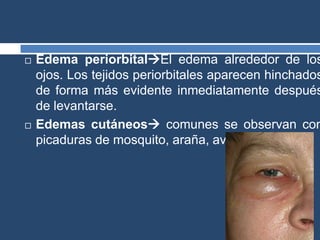  Edema periorbitalEl edema alrededor de los
ojos. Los tejidos periorbitales aparecen hinchados
de forma más evidente inmediatamente después
de levantarse.
 Edemas cutáneos comunes se observan con
picaduras de mosquito, araña, avispa o abeja,.
 